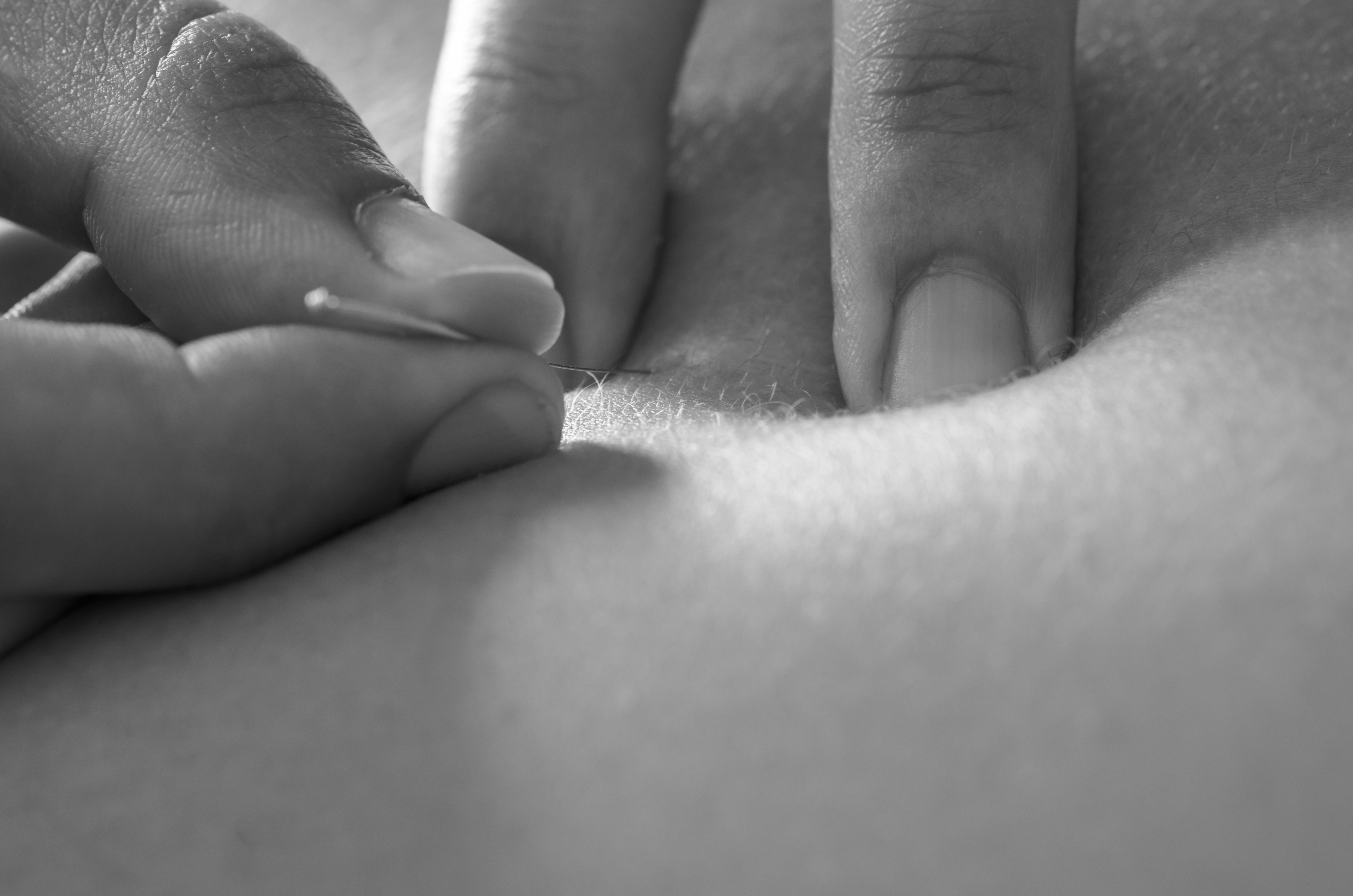 needling with compression:trapping (trigger point) black and white